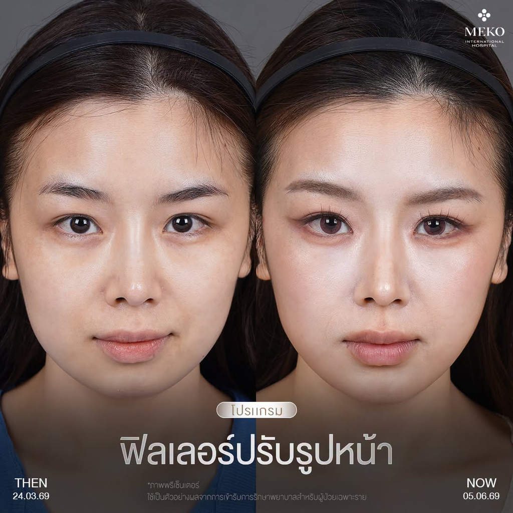 รีวิวฉีดฟิลเลอร์คางที่ Meko Clinic