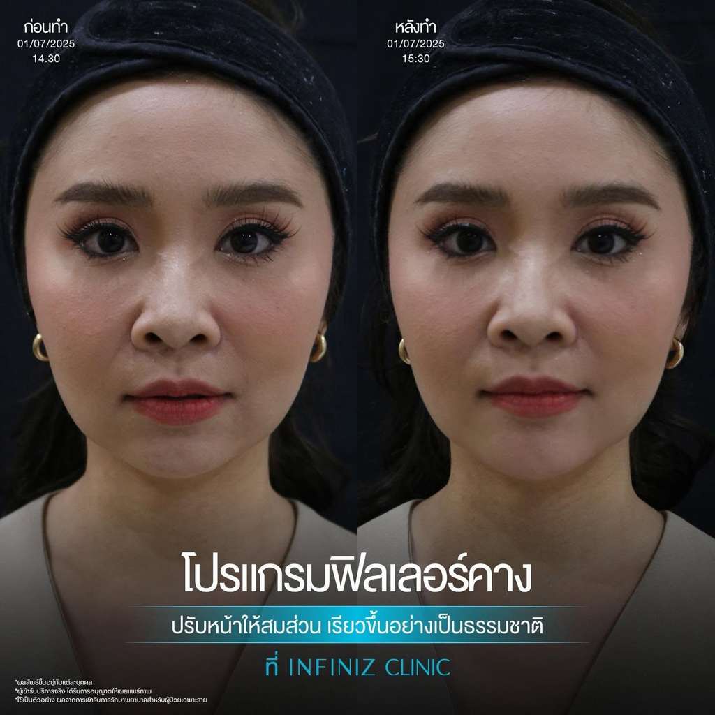 รีวิวฉีดฟิลเลอร์คางที่ Infiniz Clinic