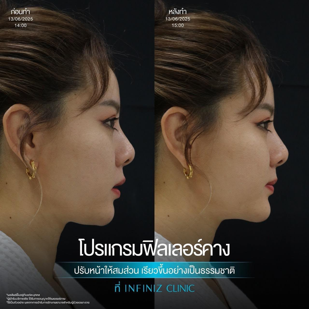รีวิวฉีดฟิลเลอร์คางที่ Infiniz Clinic