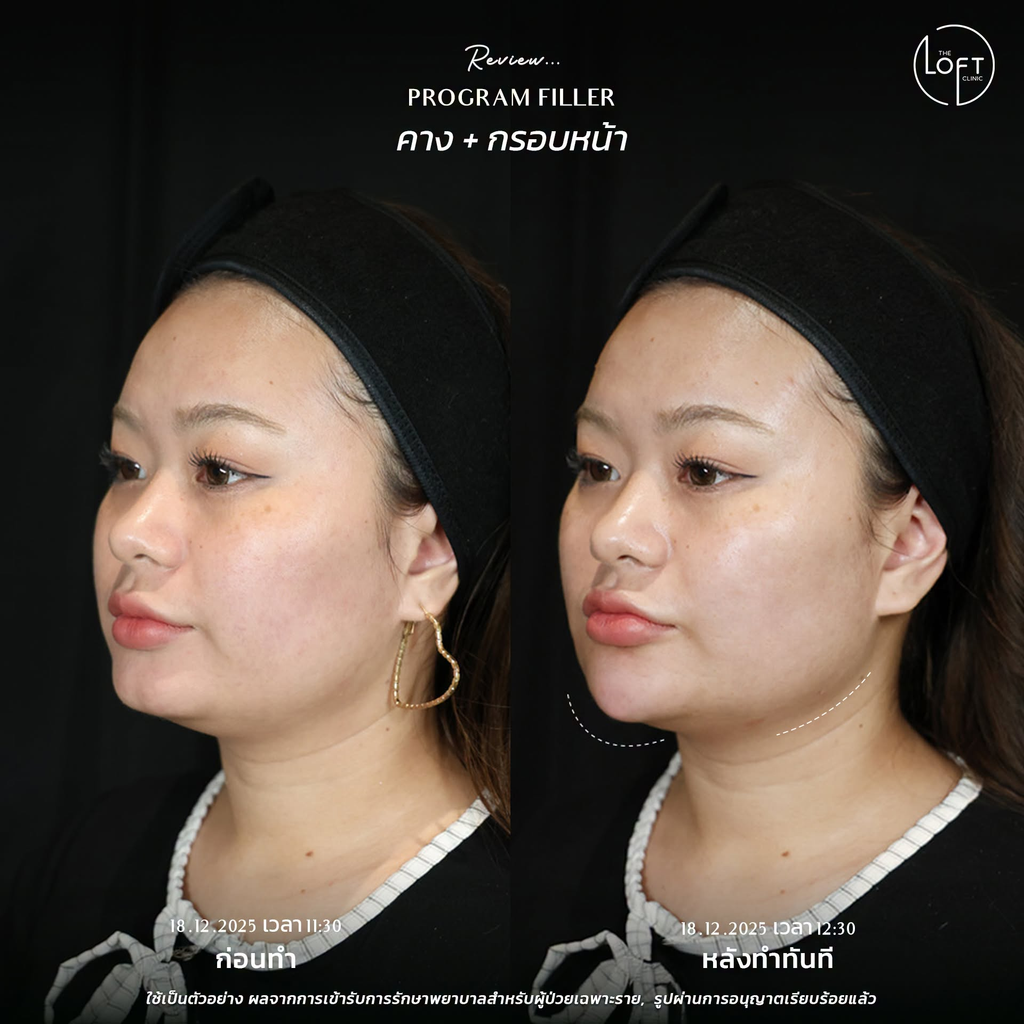รีวิวฉีดฟิลเลอร์คางที่ The Loft Clinic