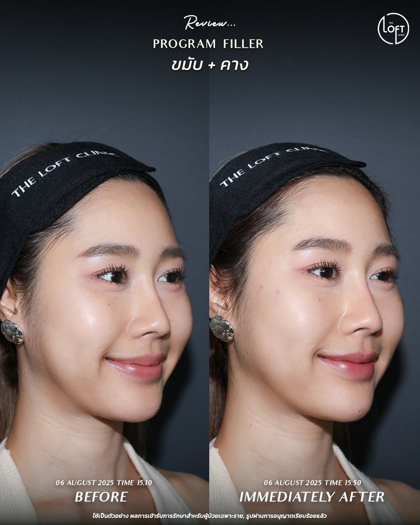รีวิวฉีดฟิลเลอร์คางที่ The Loft Clinic