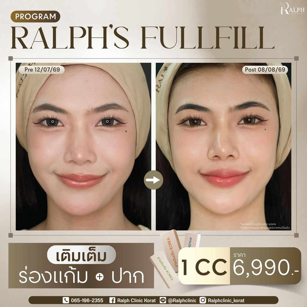 รีวิวฉีดฟิลเลอร์โคราชที่ Ralph Clinic Korat