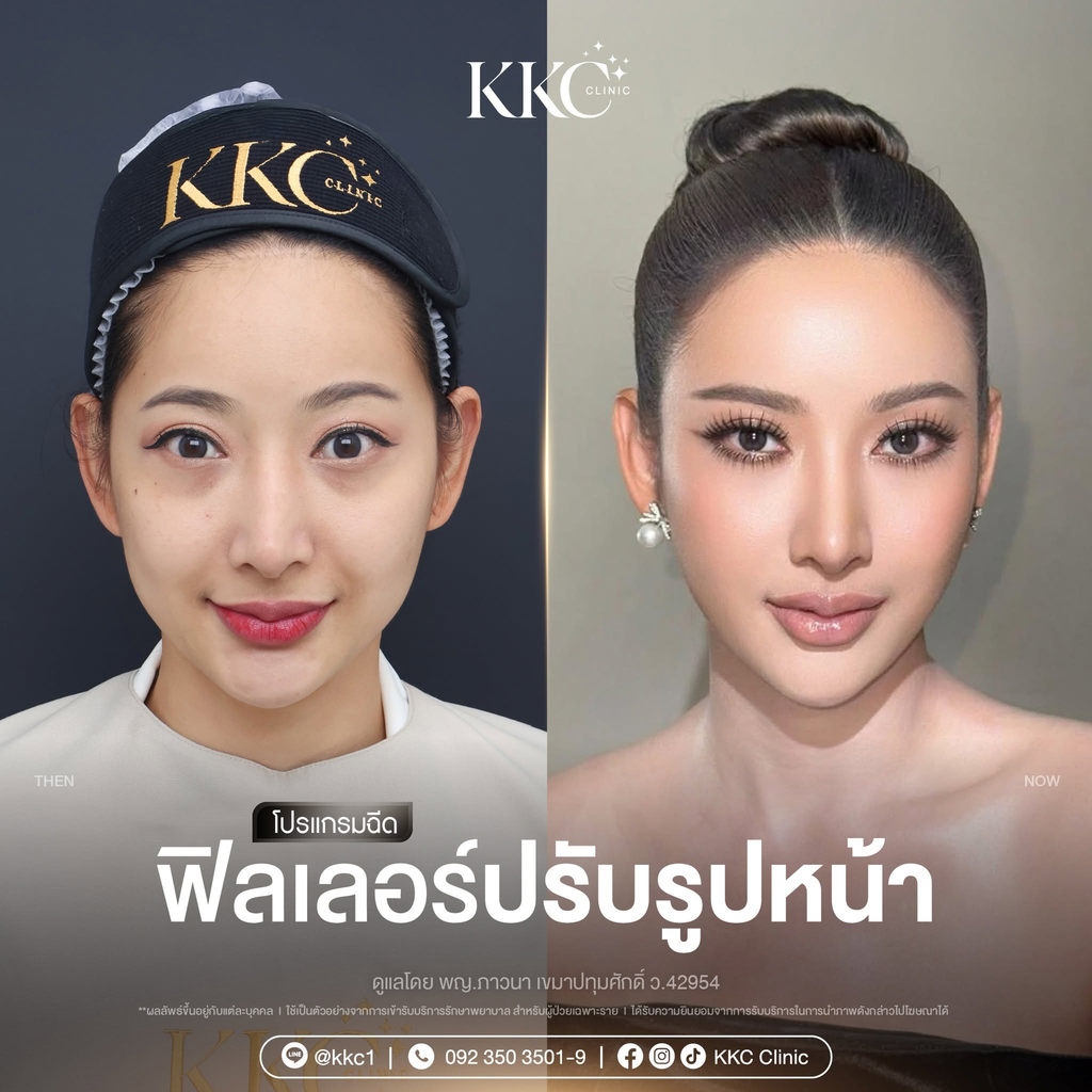 รีวิวฉีดฟิลเลอร์คางที่ KKC Clinic