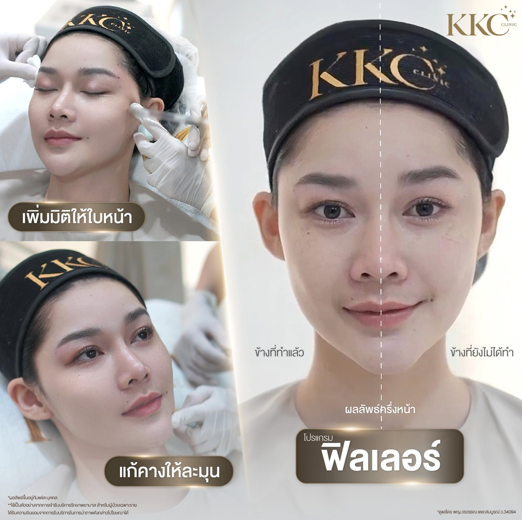 รีวิวฉีดฟิลเลอร์คางที่ KKC Clinic