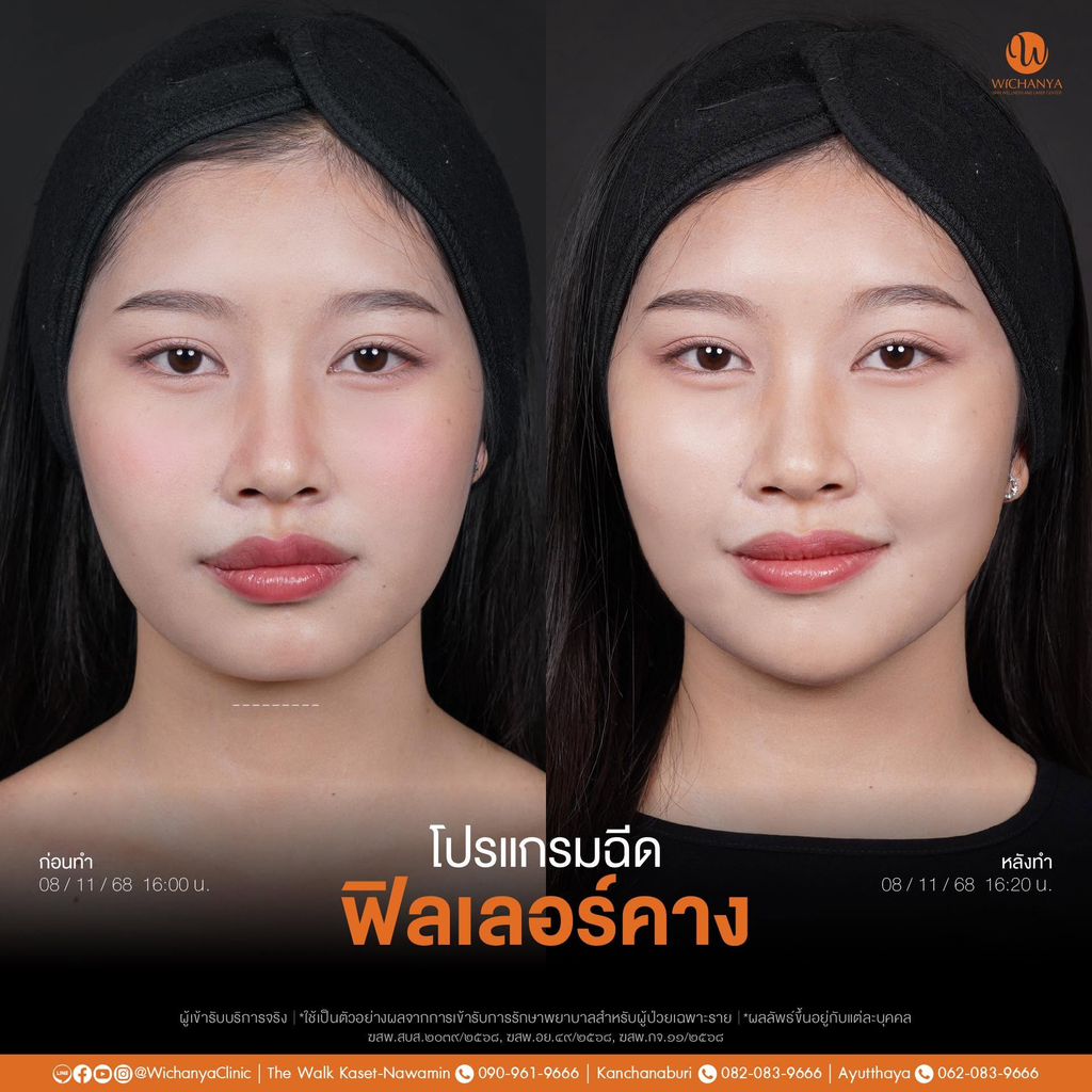 รีวิวฉีดฟิลเลอร์คางที่ Wichanya Clinic