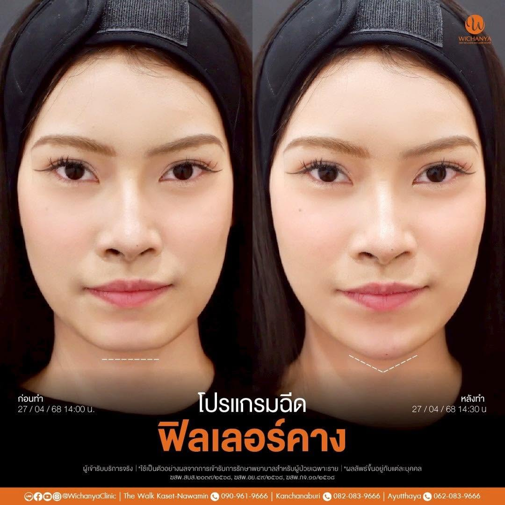 รีวิวฉีดฟิลเลอร์คางที่ Wichanya Clinic