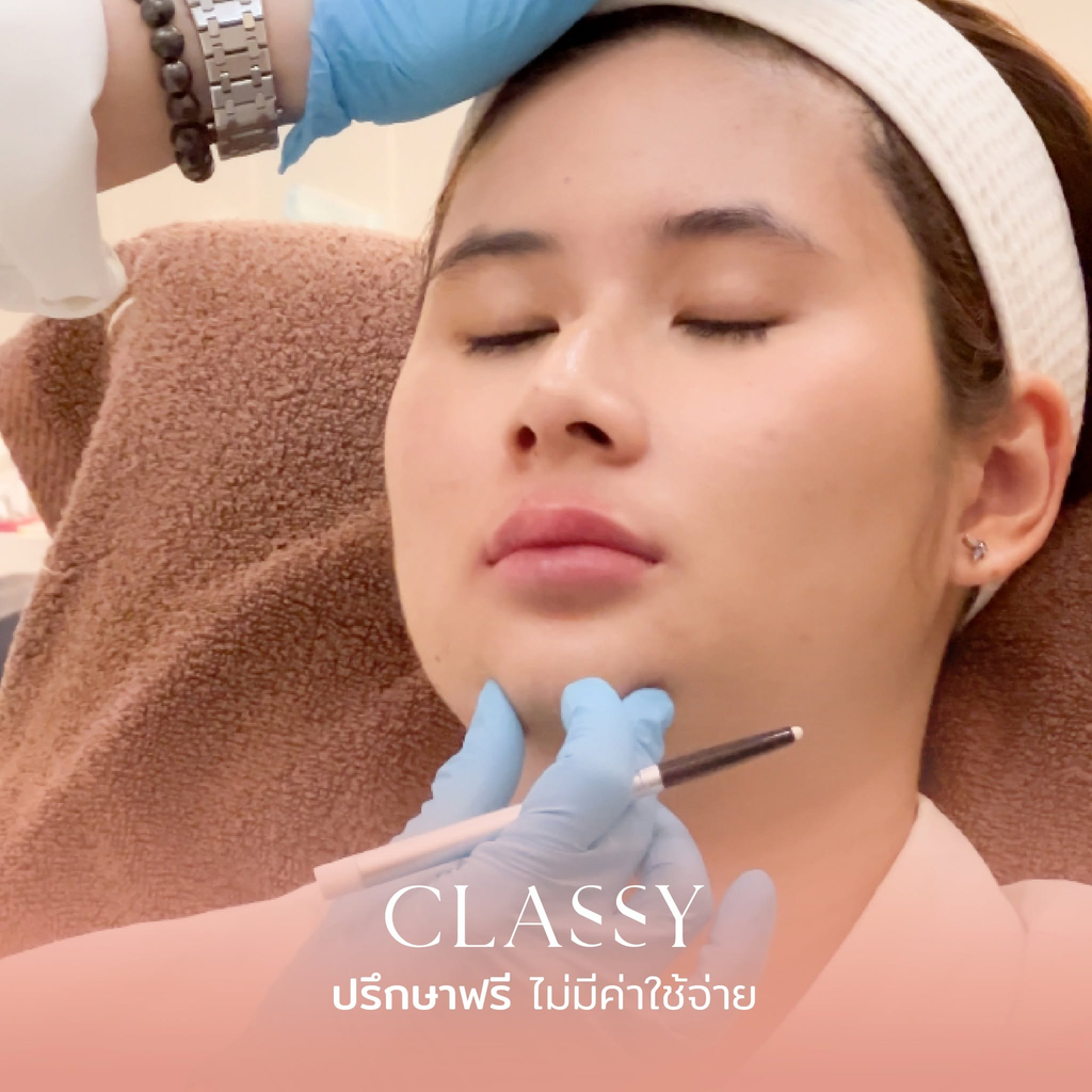 รีวิวฉีดฟิลเลอร์คางที่ Classy Clinic