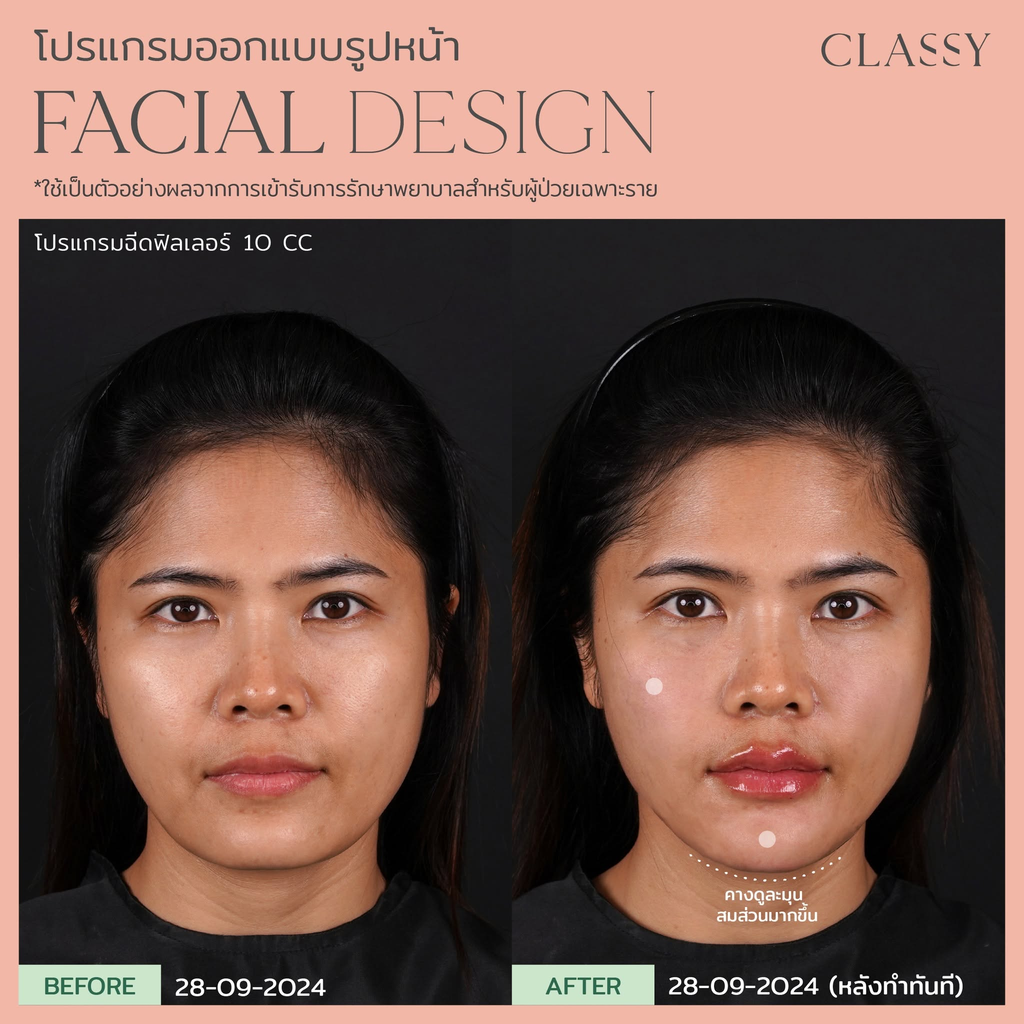 รีวิวฉีดฟิลเลอร์คางที่ Classy Clinic
