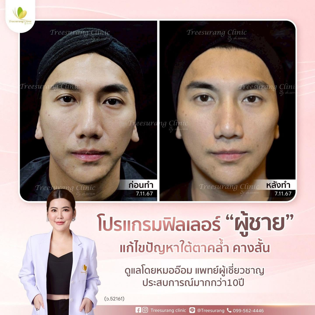 รีวิวฉีดฟิลเลอร์คางที่ Treesurang Clinic