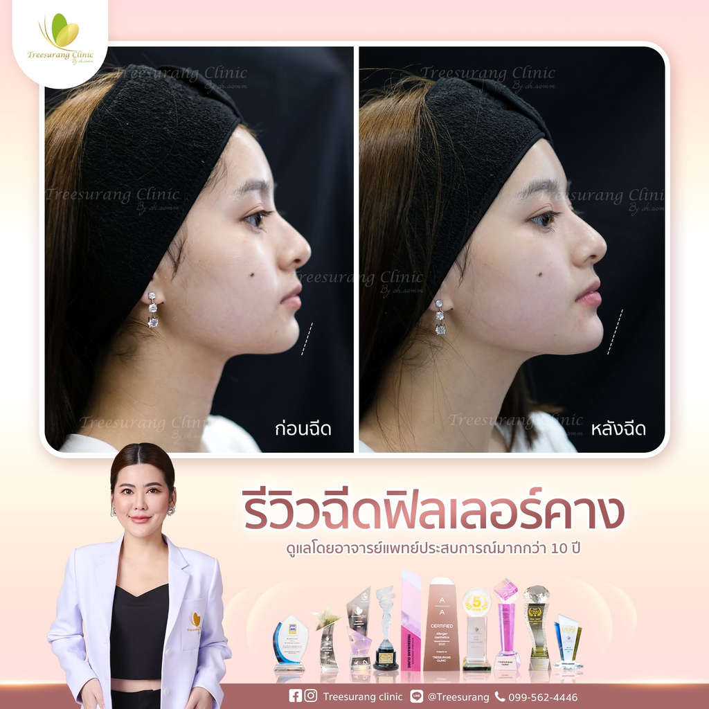 รีวิวฉีดฟิลเลอร์คางที่ Treesurang Clinic