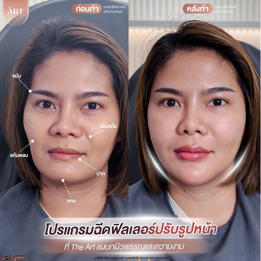 รีวิวฉีดฟิลเลอร์คางที่ The Art Hospital & Clinic