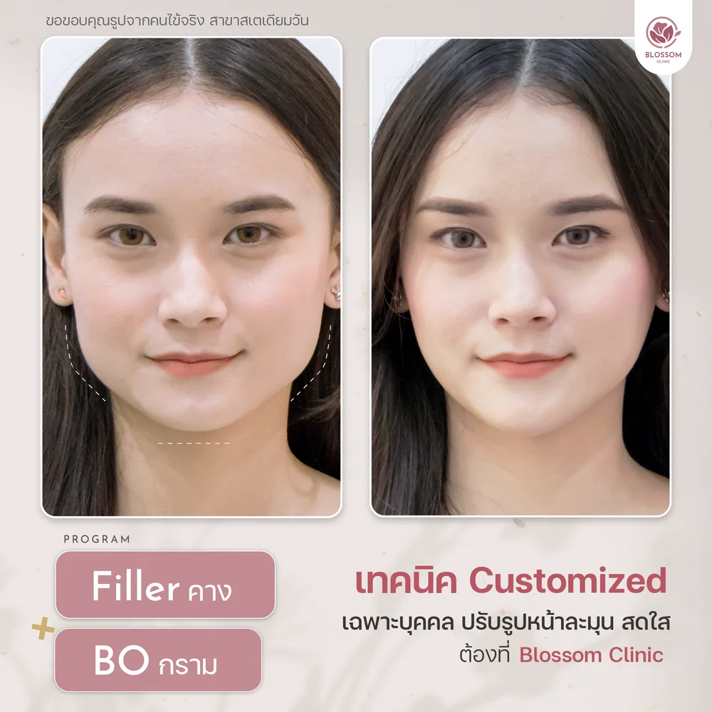 รีวิวฉีดฟิลเลอร์คางที่ Blossom Clinic