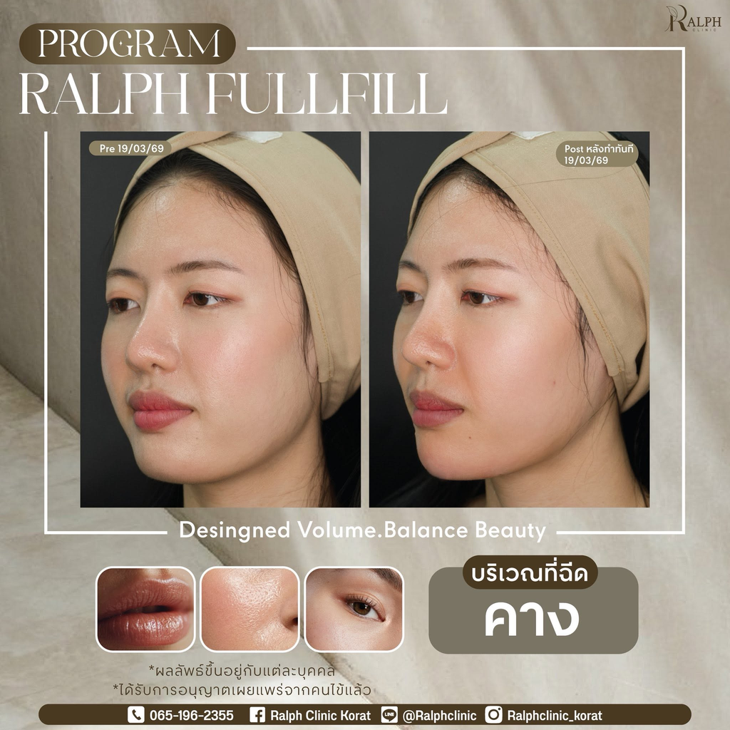 รีวิวฉีดฟิลเลอร์โคราชที่ Ralph Clinic Korat