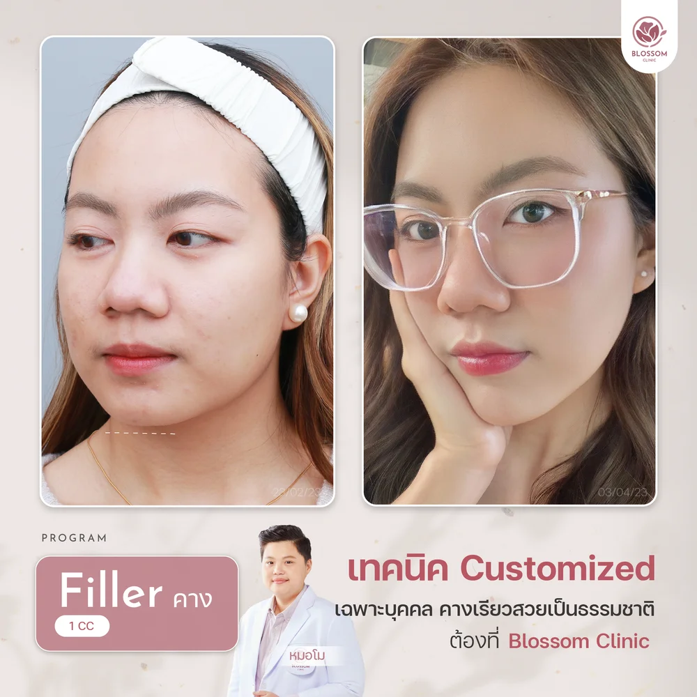 รีวิวฉีดฟิลเลอร์คางที่ Blossom Clinic