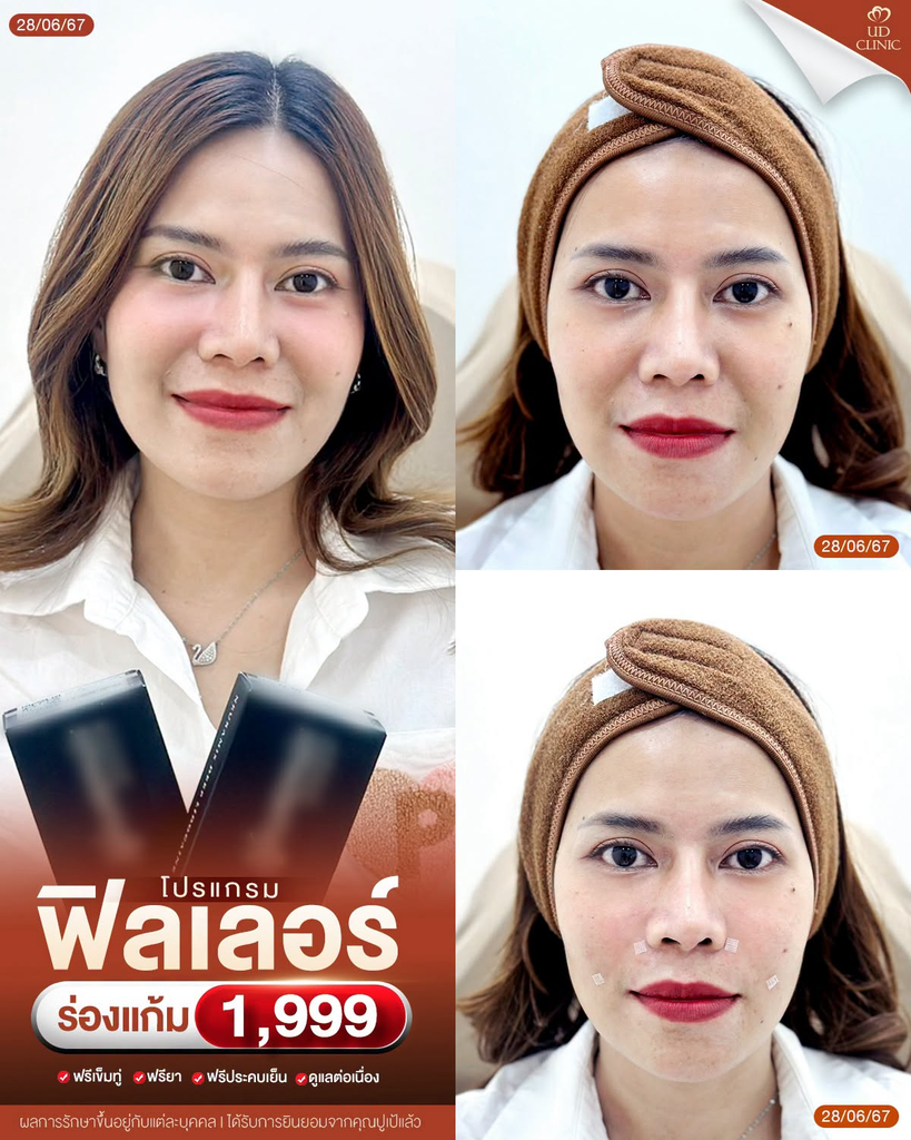 รีวิวฉีดฟิลเลอร์โคราชที่ UD Clinic
