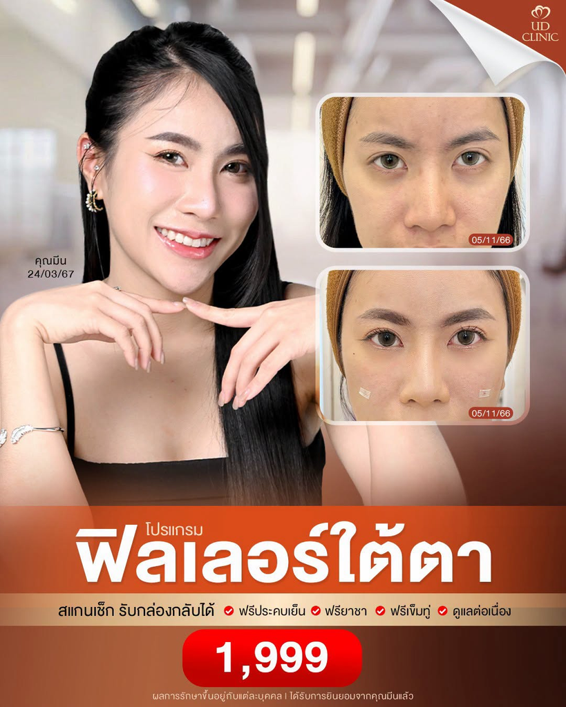 รีวิวฉีดฟิลเลอร์โคราชที่ UD Clinic