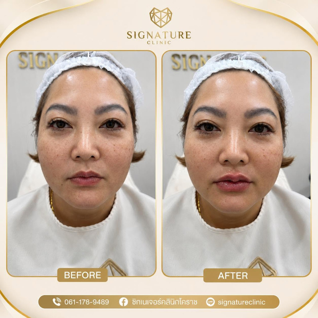 รีวิวฉีดฟิลเลอร์โคราชที่ Signature Clinic Korat
