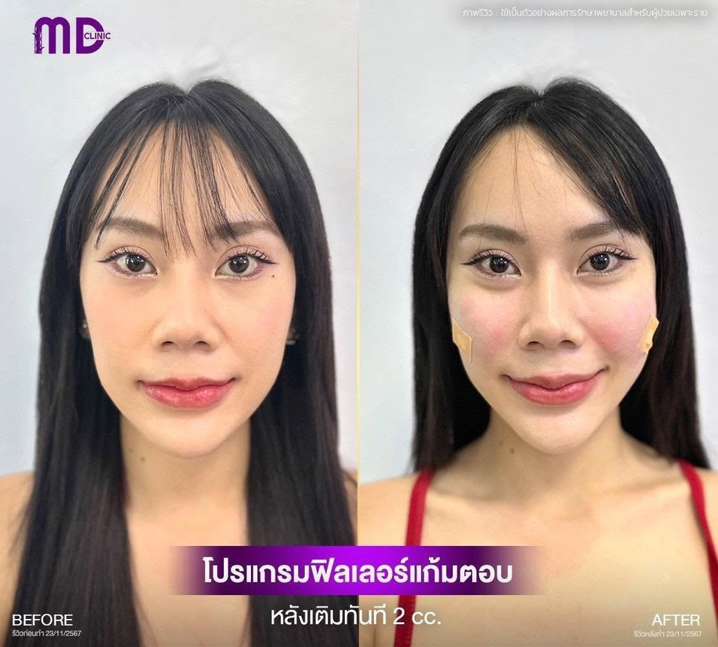 รีวิวฉีดฟิลเลอร์โคราชที่ MD Clinic