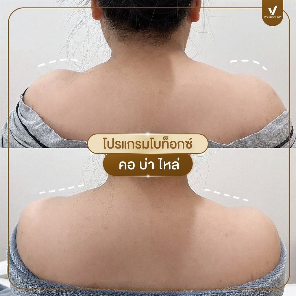 รีวิวคลินิกฉีดโบท็อกซ์โคราชที่ V Sure Clinic