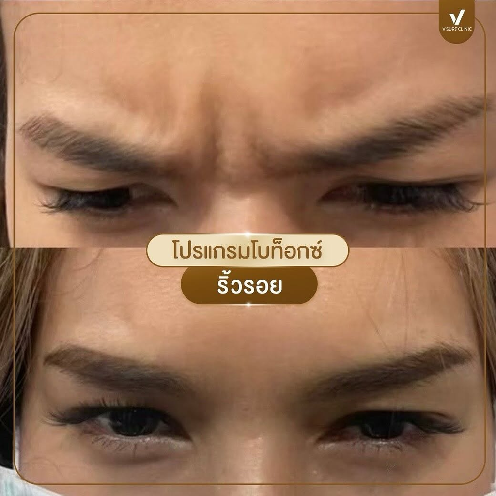 รีวิวคลินิกฉีดโบท็อกซ์โคราชที่ V Sure Clinic