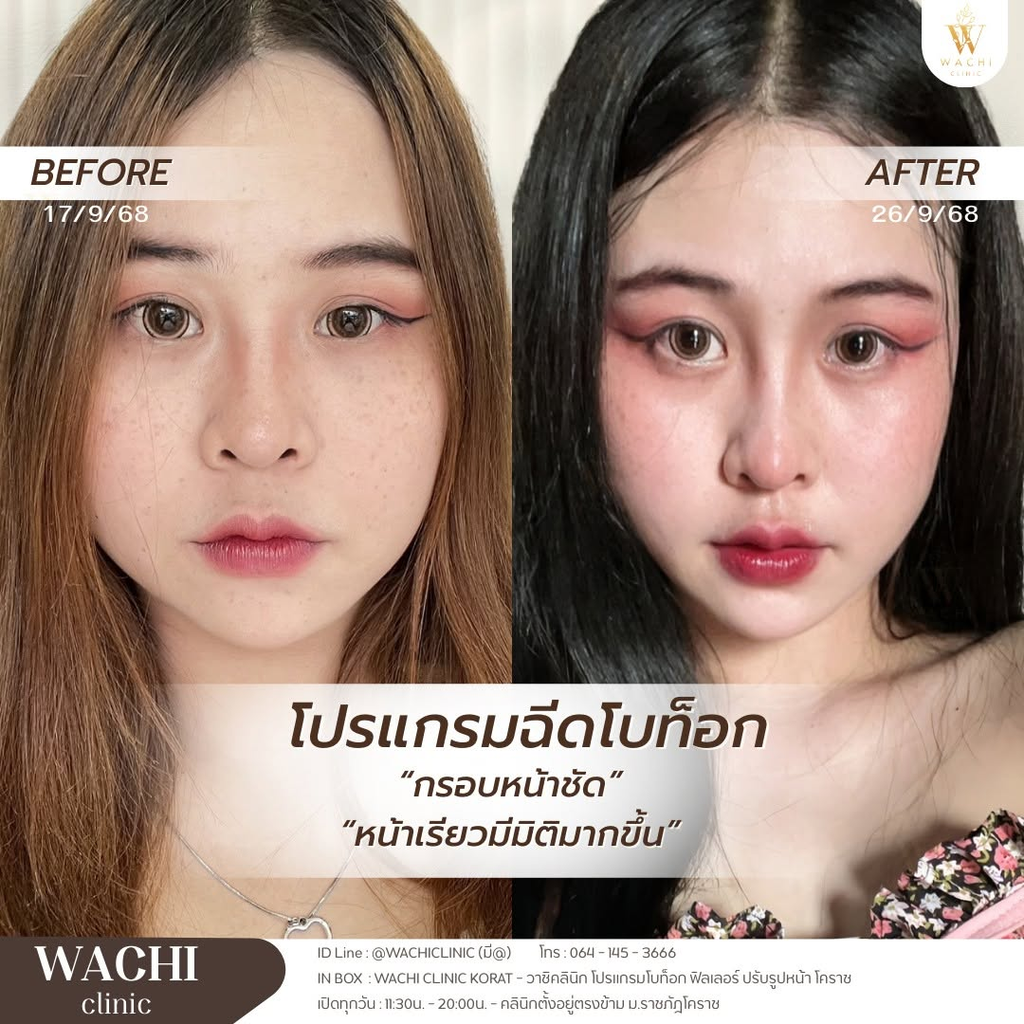 รีวิวคลินิกฉีดโบท็อกซ์โคราชที่ Wachi Clinic