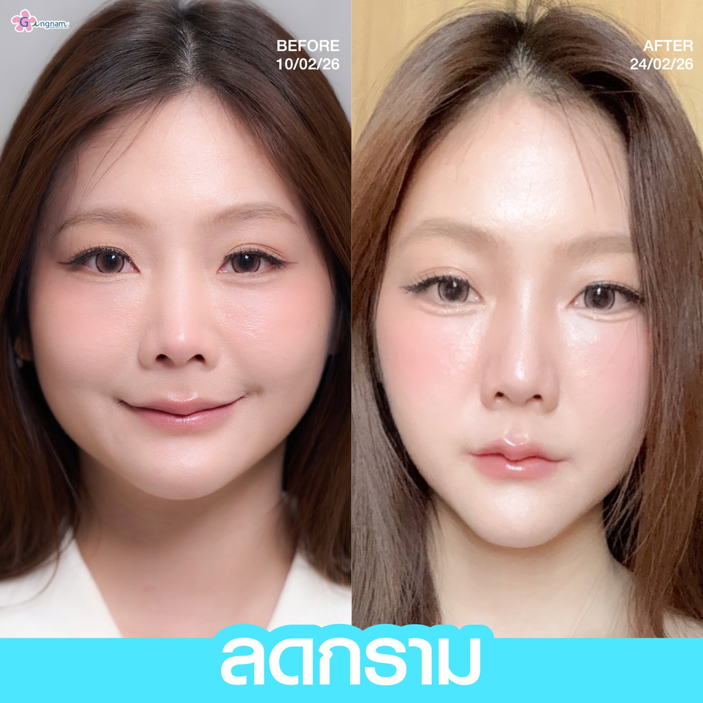 รีวิวคลินิกฉีดโบท็อกซ์โคราชที่ Gangnam Clinic