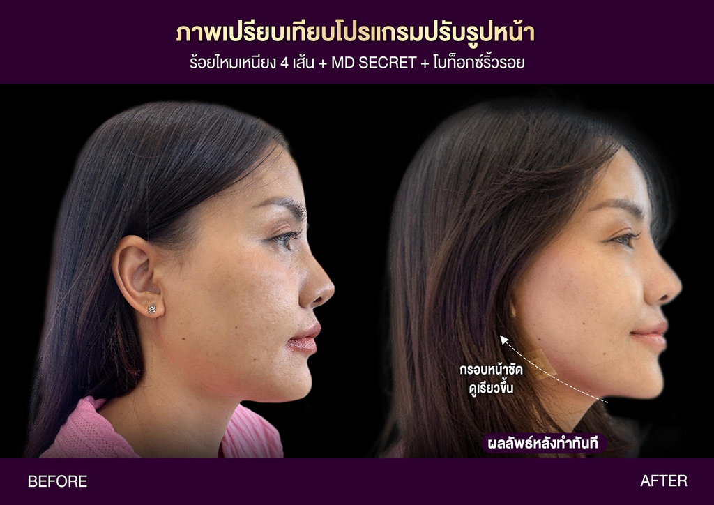 รีวิวคลินิกฉีดโบท็อกซ์โคราชที่ MD Clinic