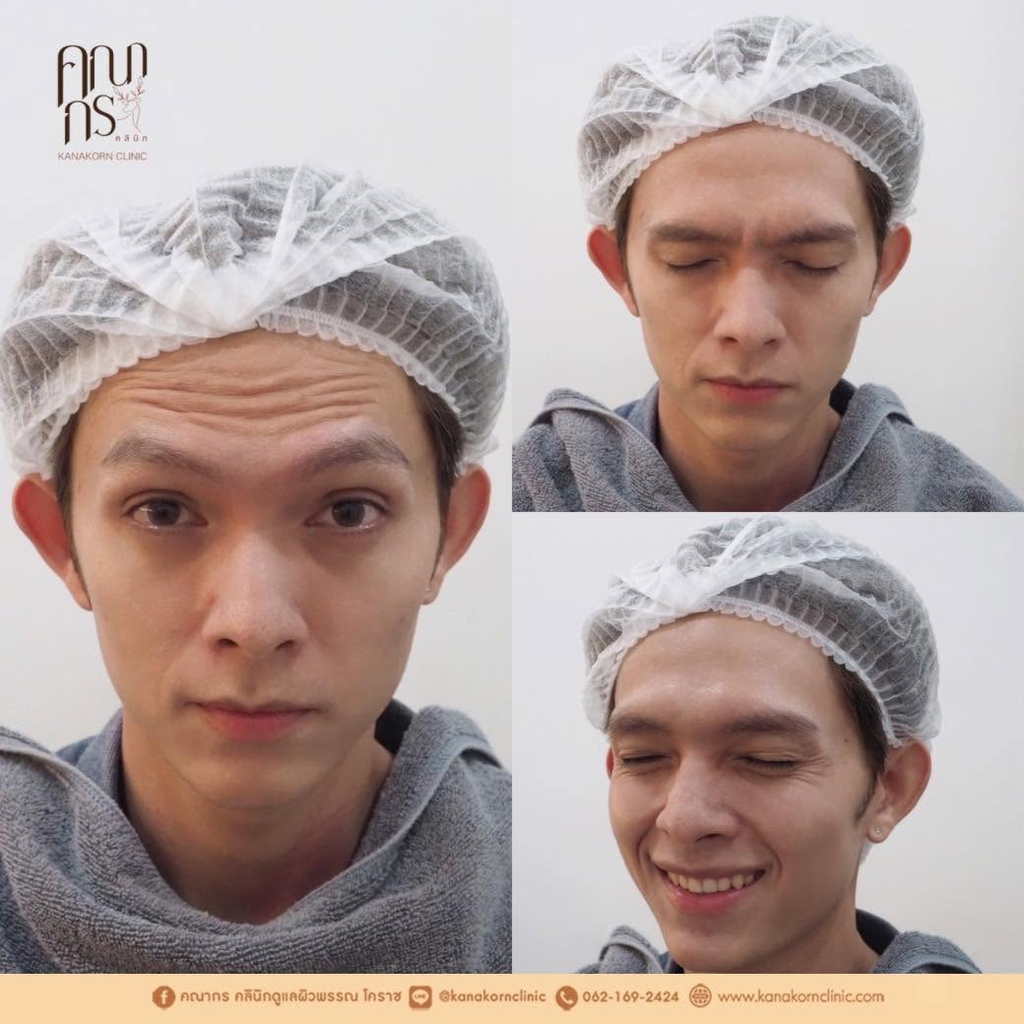 รีวิวคลินิกฉีดโบท็อกซ์โคราชที่ คณากรคลินิก