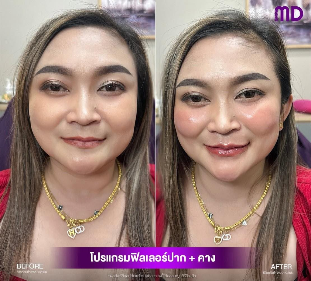 รีวิวฉีดฟิลเลอร์โคราชที่ MD Clinic