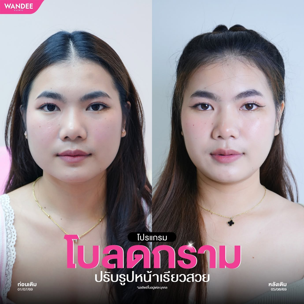 รีวิวคลินิกฉีดโบท็อกซ์โคราชที่ Wandee Clinic