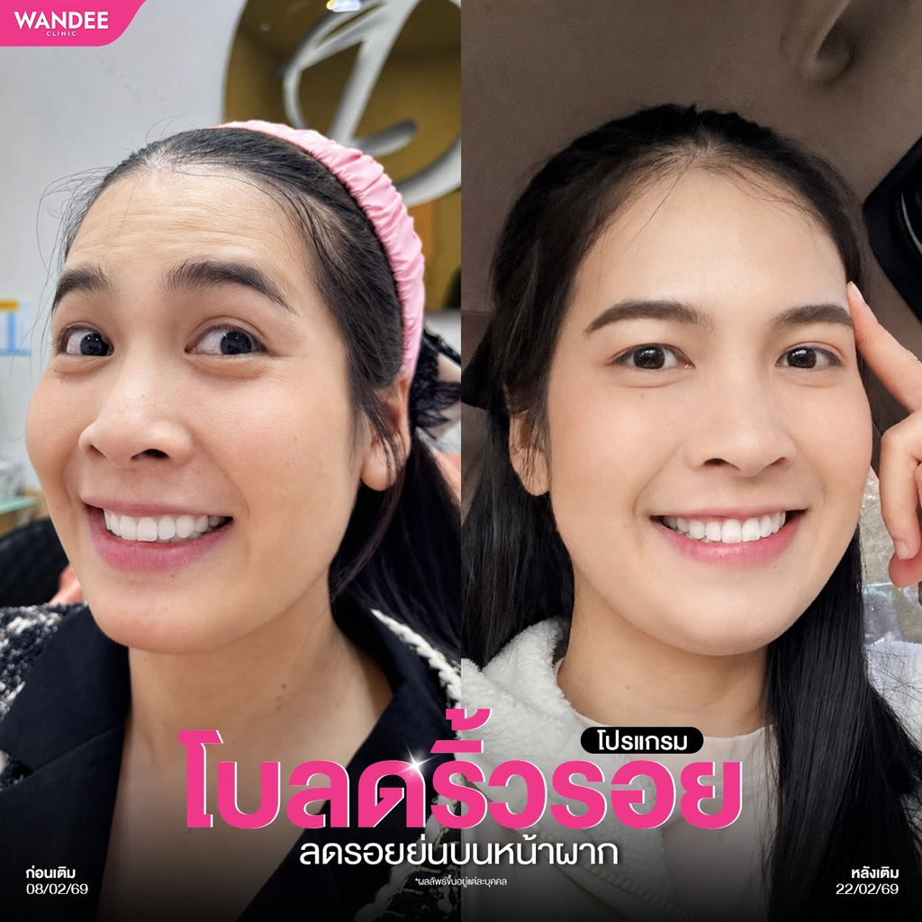 รีวิวคลินิกฉีดโบท็อกซ์โคราชที่ Wandee Clinic