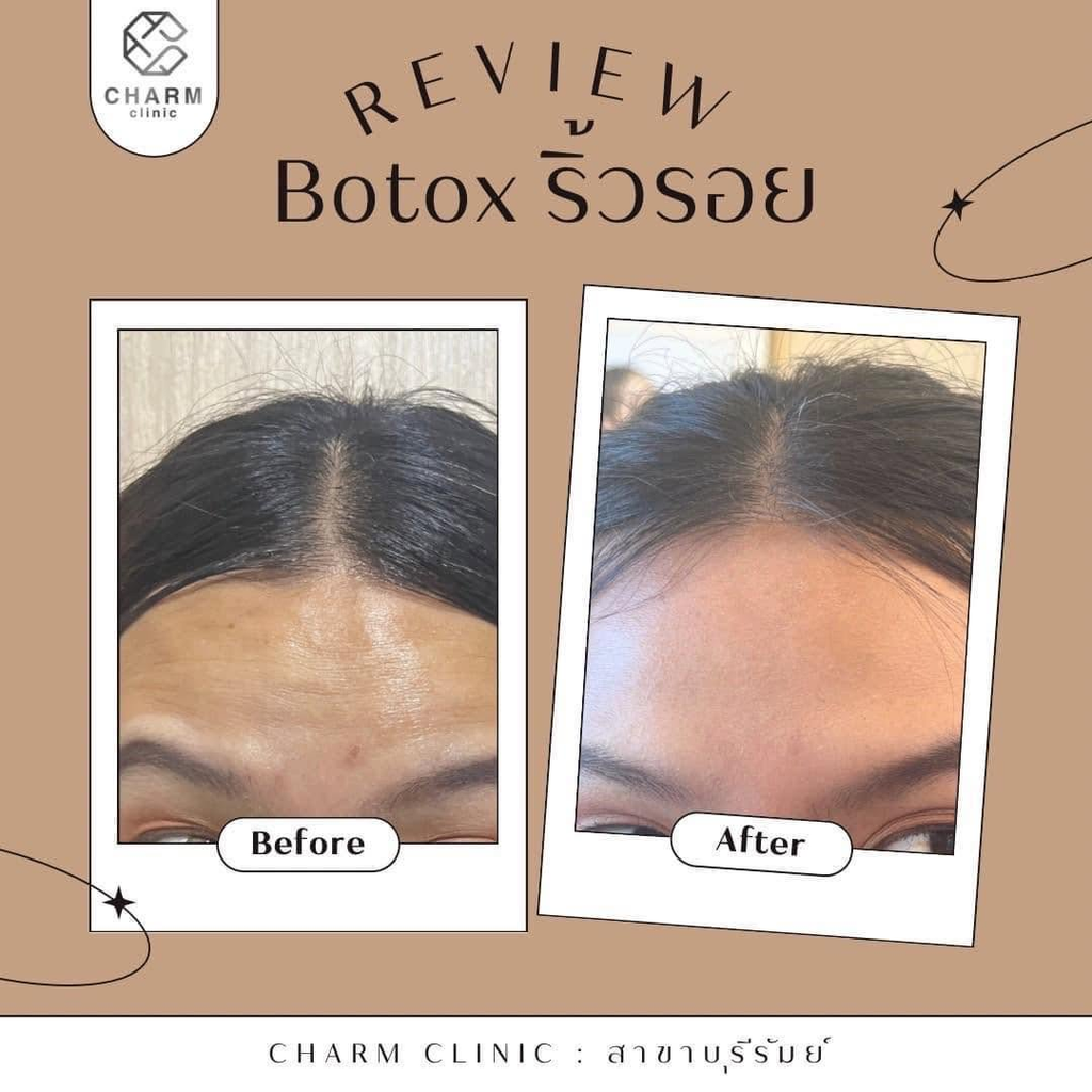 รีวิวคลินิกฉีดโบท็อกซ์โคราชที่ CHARM Clinic