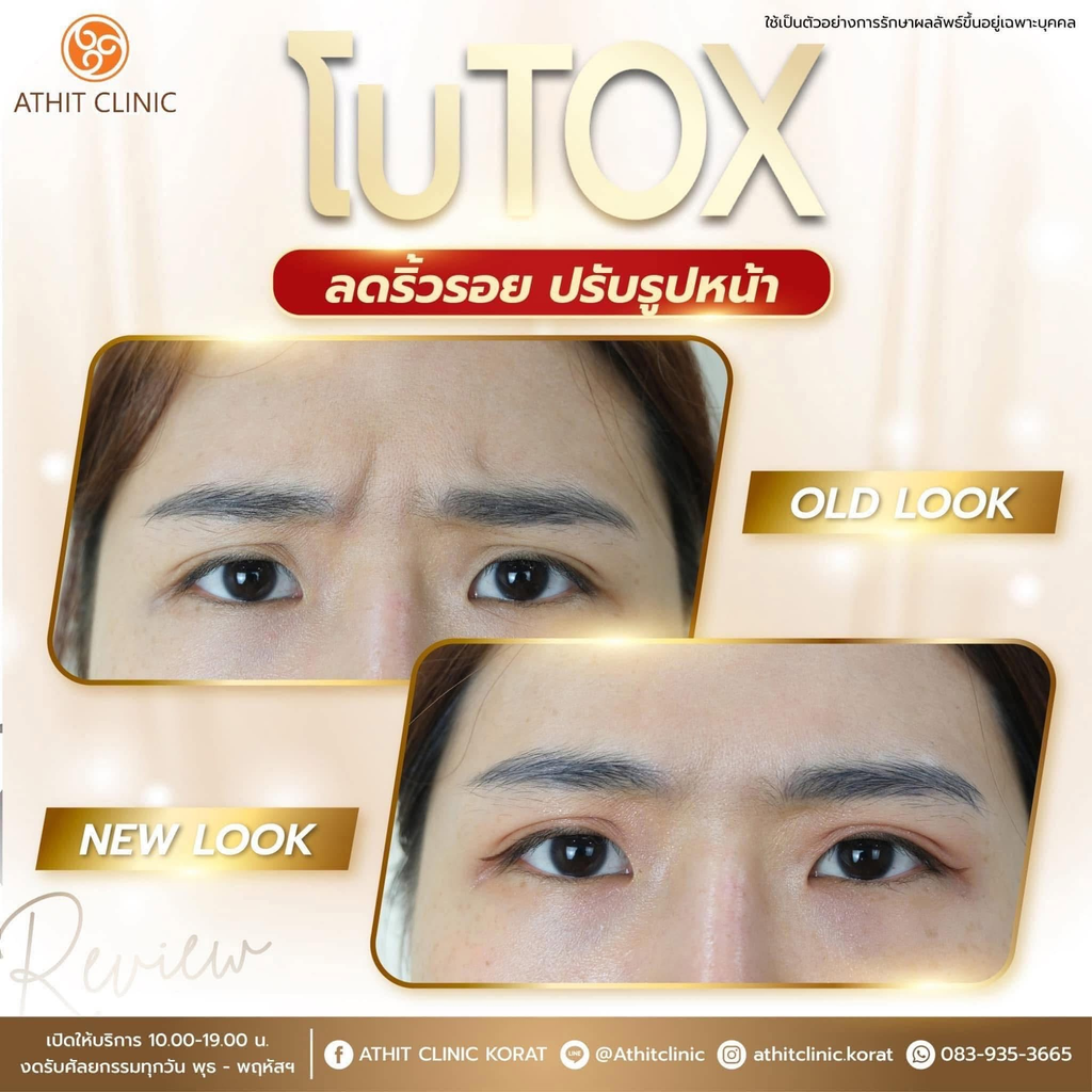 รีวิวคลินิกฉีดโบท็อกซ์โคราชที่ Athit Clinic