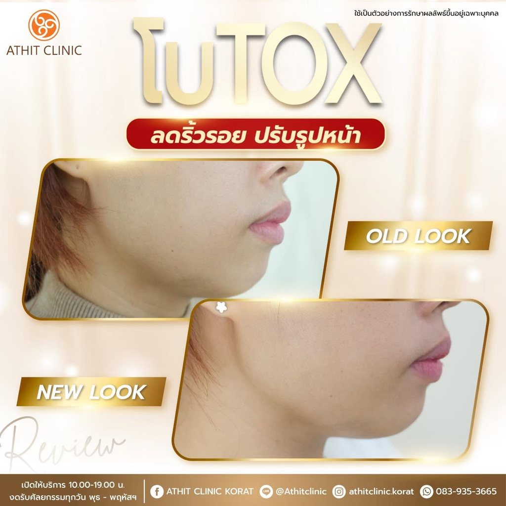 รีวิวคลินิกฉีดโบท็อกซ์โคราชที่ Athit Clinic