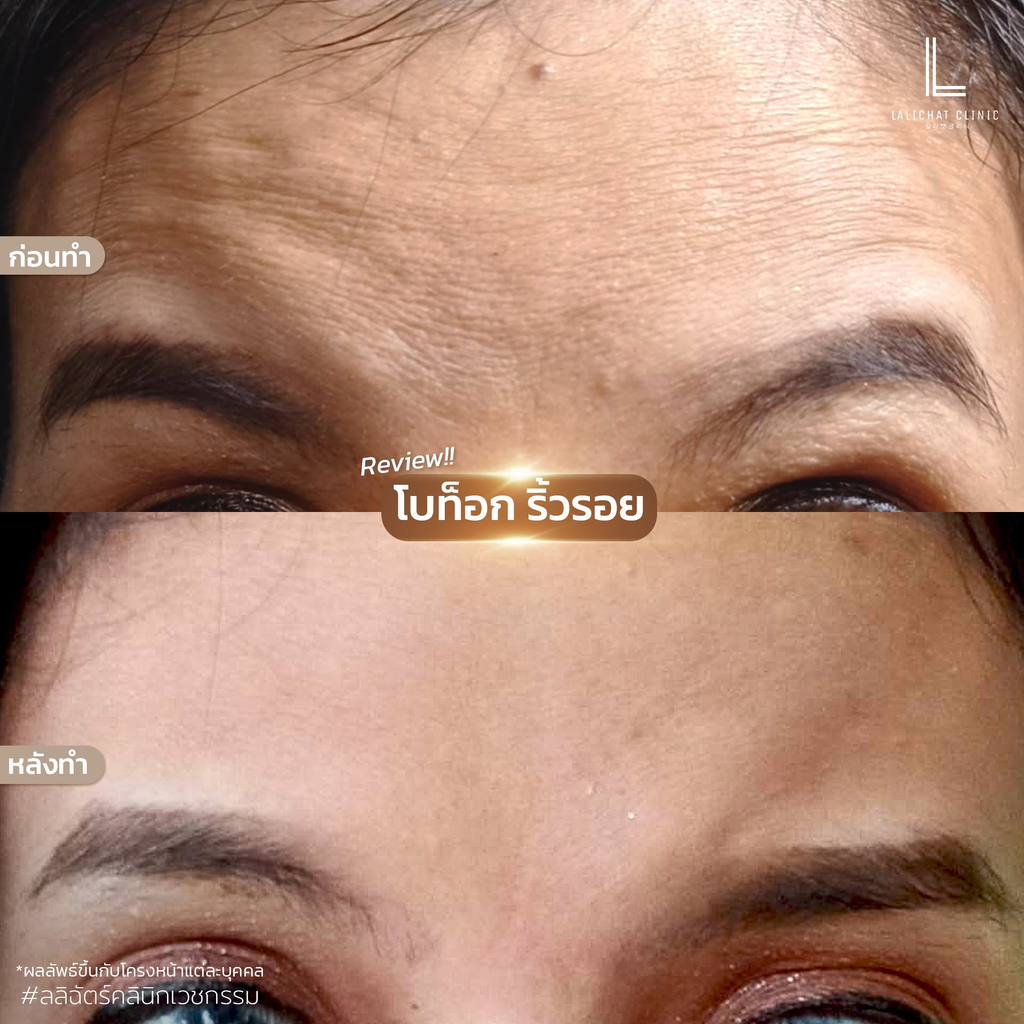 รีวิวคลินิกฉีดโบท็อกซ์โคราชที่ Lalichat clinic