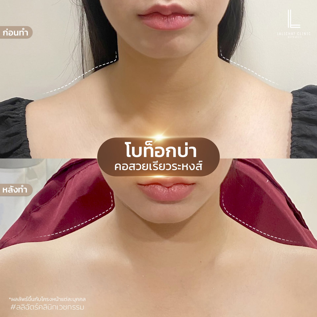 รีวิวคลินิกฉีดโบท็อกซ์โคราชที่ Lalichat clinic