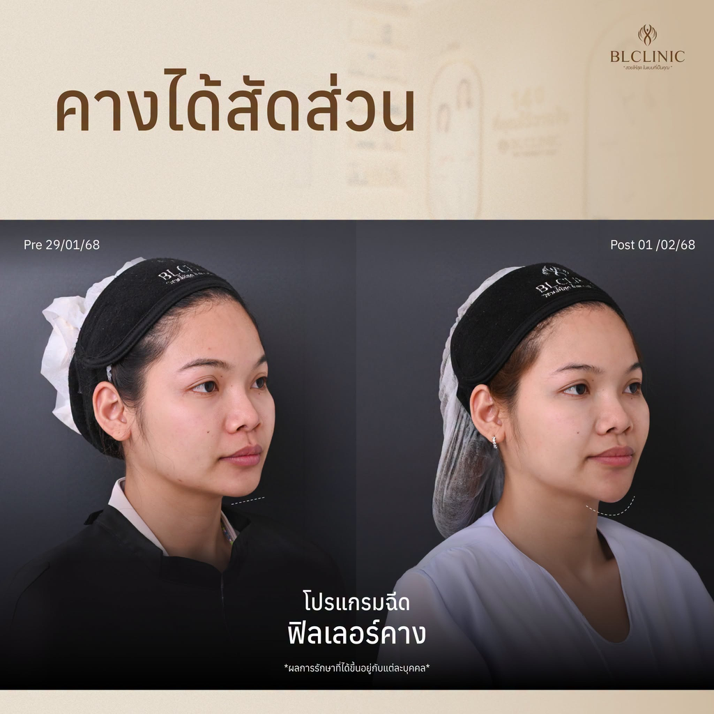 รีวิวฉีดฟิลเลอร์โคราชที่ BL Clinic