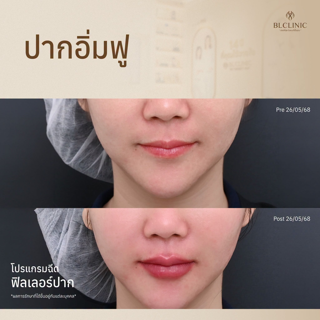 รีวิวฉีดฟิลเลอร์โคราชที่ BL Clinic