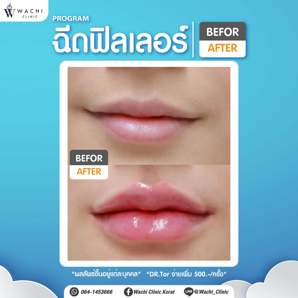 รีวิวฉีดฟิลเลอร์โคราชที่ Wachi Clinic