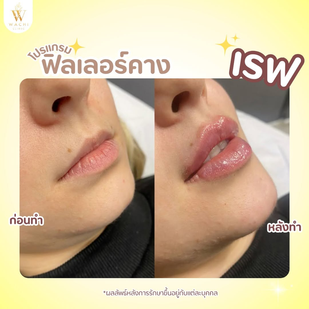 รีวิวฉีดฟิลเลอร์โคราชที่ Wachi Clinic