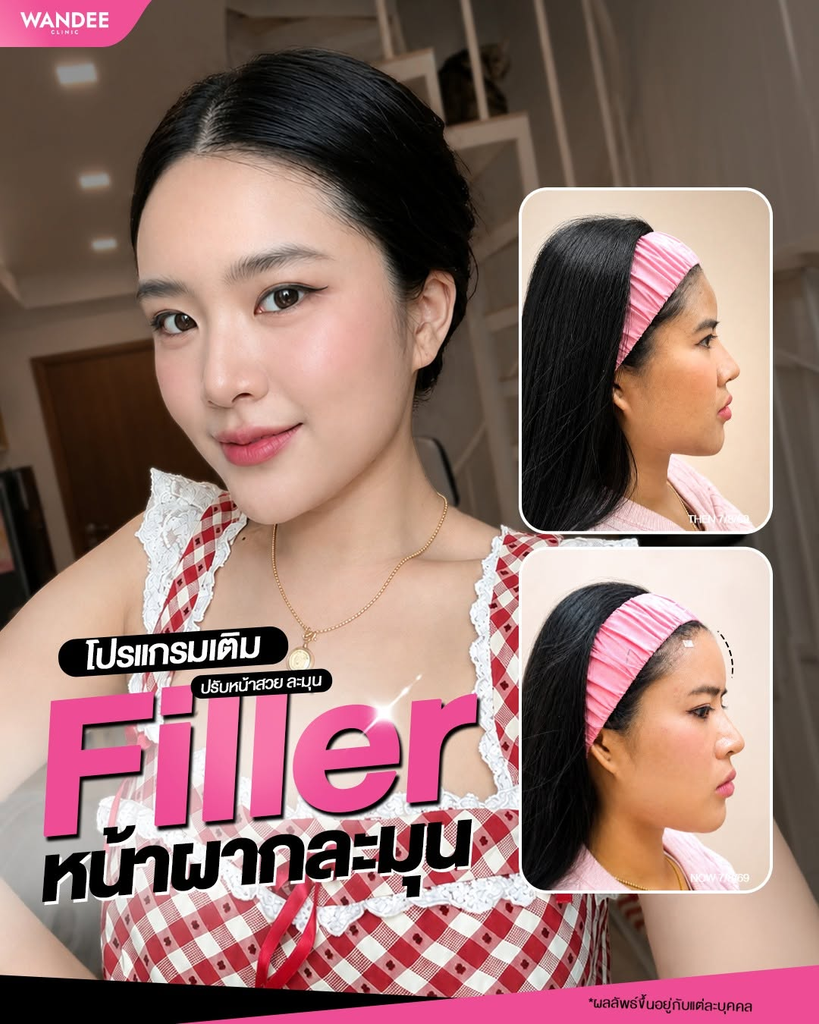 รีวิวฉีดฟิลเลอร์โคราชที่ Wandee Clinic