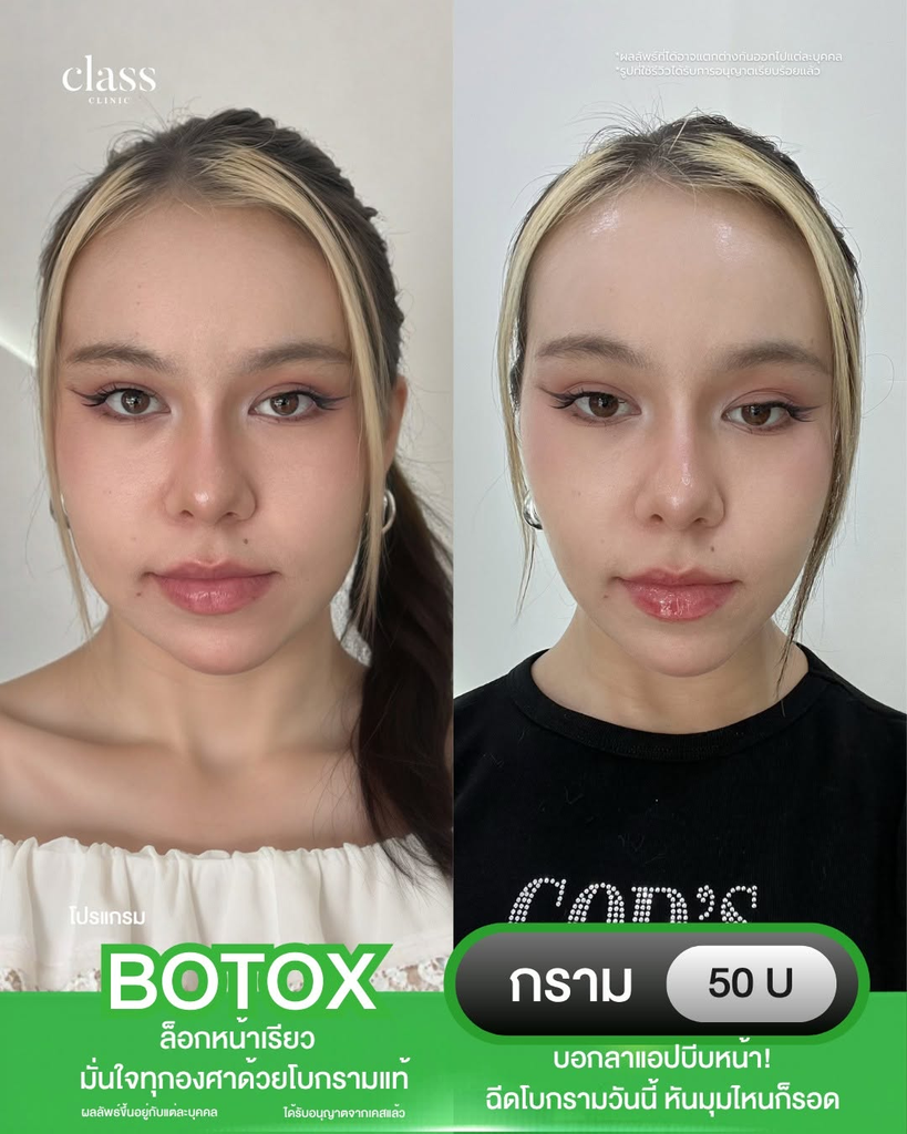 รีวิวคลินิกฉีดโบท็อกซ์โคราชที่ Class Clinic
