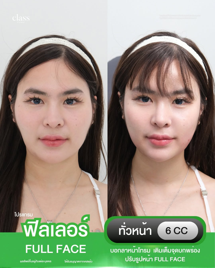 รีวิวฉีดฟิลเลอร์โคราชที่ Class Clinic