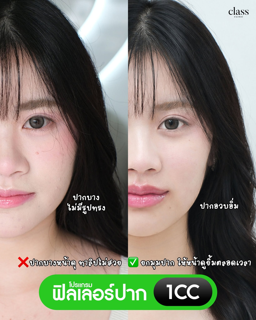 รีวิวฉีดฟิลเลอร์โคราชที่ Class Clinic