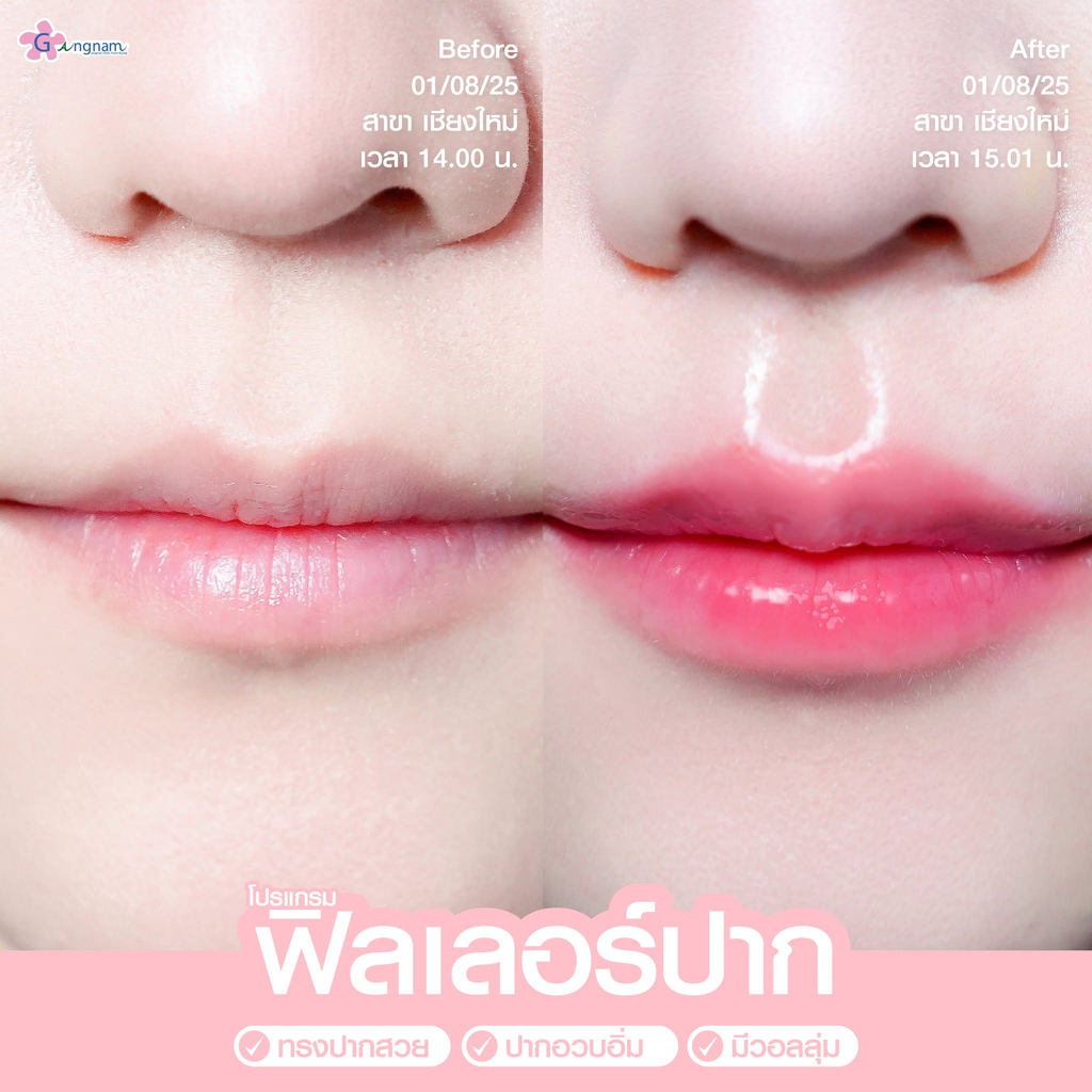 รีวิวฉีดฟิลเลอร์ปากที่ GANGNAM Clinic