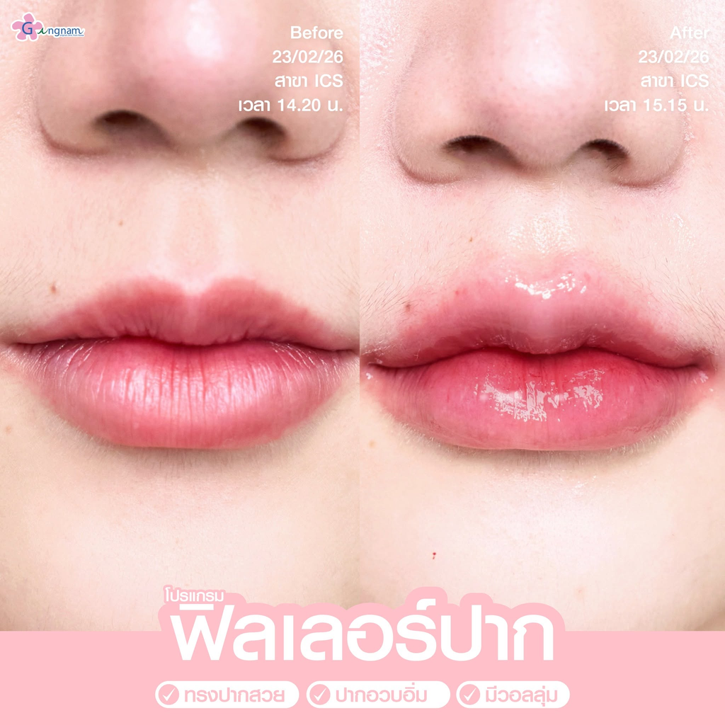 รีวิวฉีดฟิลเลอร์ปากที่ GANGNAM Clinic
