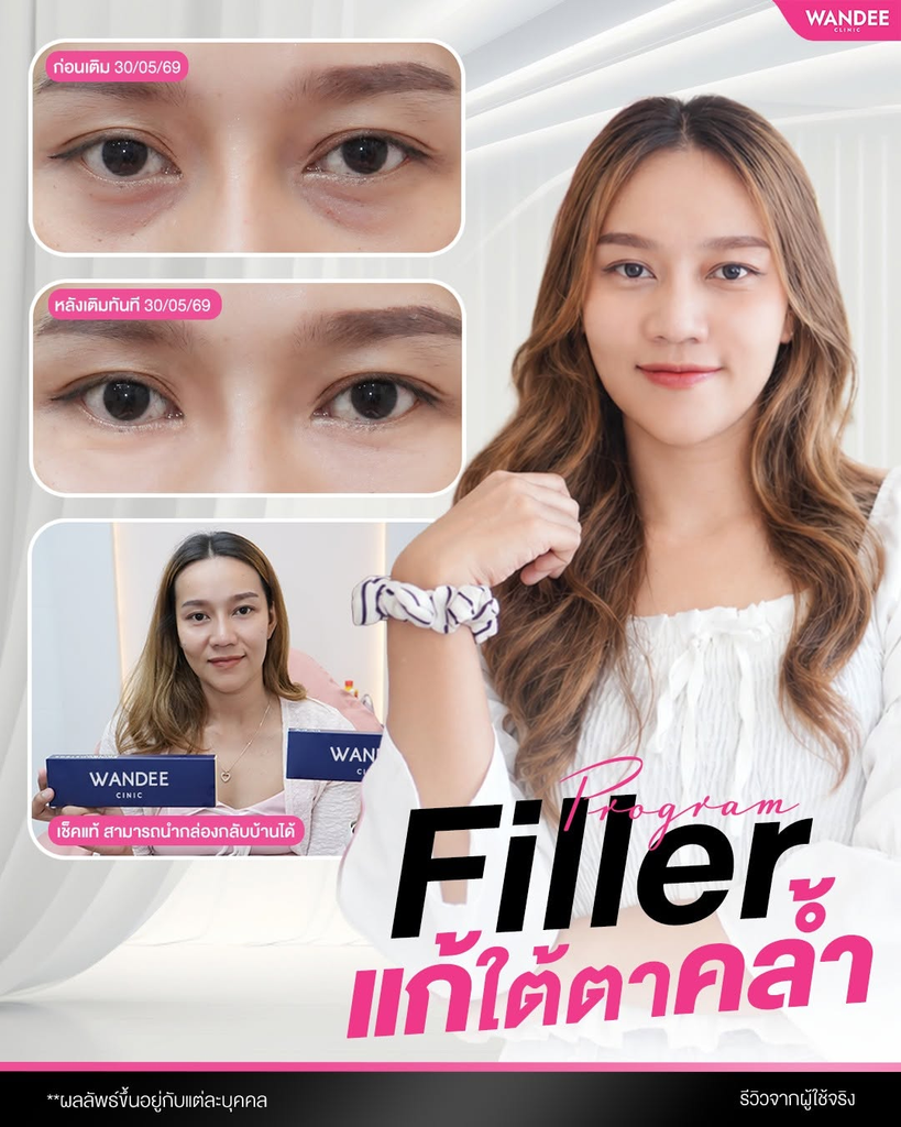 รีวิวฉีดฟิลเลอร์โคราชที่ Wandee Clinic