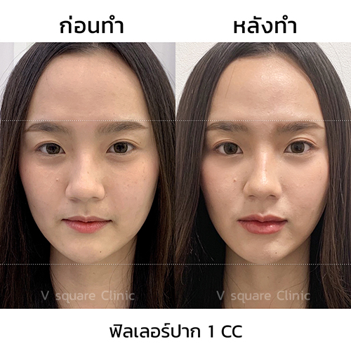 รีวิวฉีดฟิลเลอร์ปากที่ V Square Clinic
