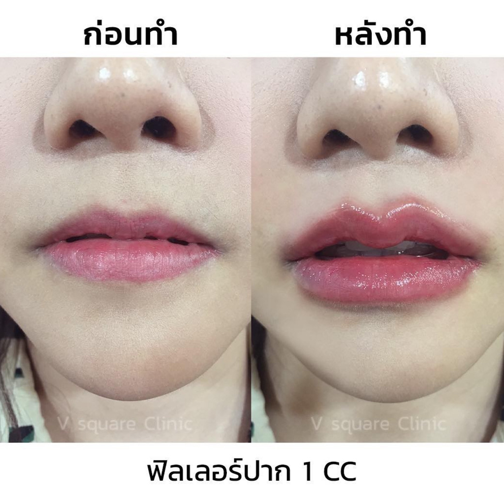 รีวิวฉีดฟิลเลอร์ปากที่ V Square Clinic