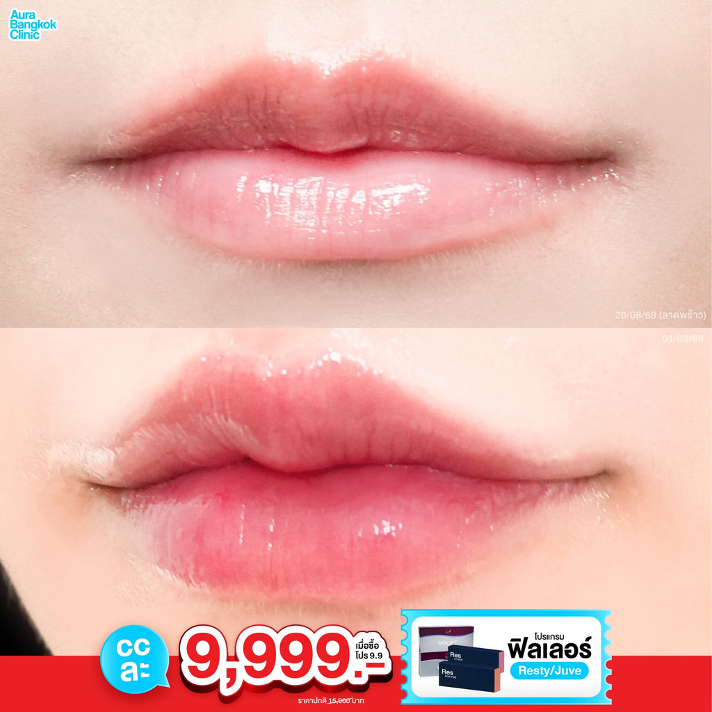 รีวิวฉีดฟิลเลอร์ปากที่ Aura Bangkok Clinic